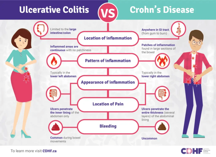 Inflammatory Bowel Disease Digital Toolkit for the Newly Diagnosed ... Inflammatory Bowel Disease Digital Toolkit for the Newly Diagnosed ...